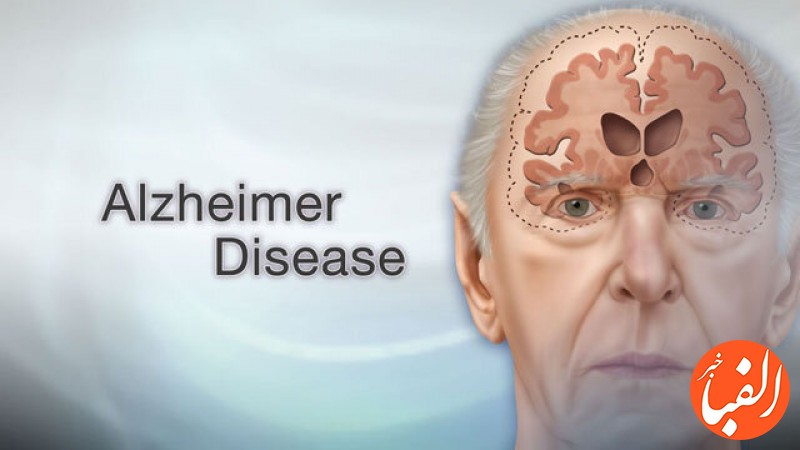 درمان-آلزایمر-ناشی-از-ضربه-مغزی-با-داروی-جدید
