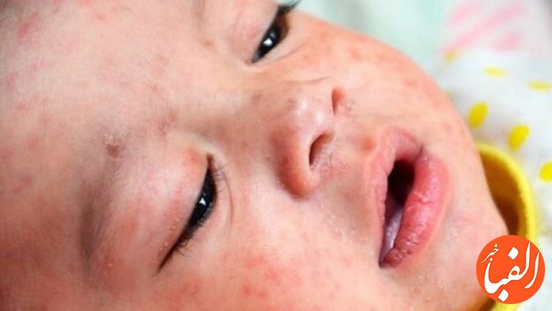علائم-سرخک-و-اهمیت-واکسیناسیون-کودکان-در-موعد-مقرر