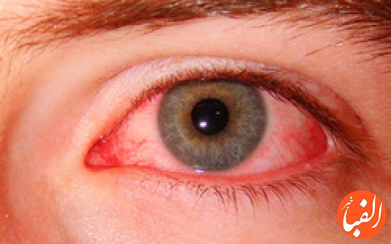 چگونه-تورم-و-قرمزی-چشم-را-با-گیاهان-دارویی-درمان-کنیم