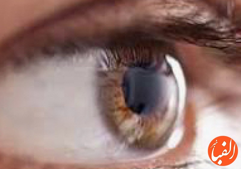 معجزه-درمان-مگس-پران-چشم-در-طب-سنتی-علت-مگس-پران-چشم